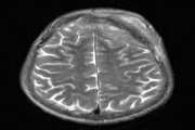 Primary diffuse large B-cell non-Hodgkin lymphoma of the cranial vault